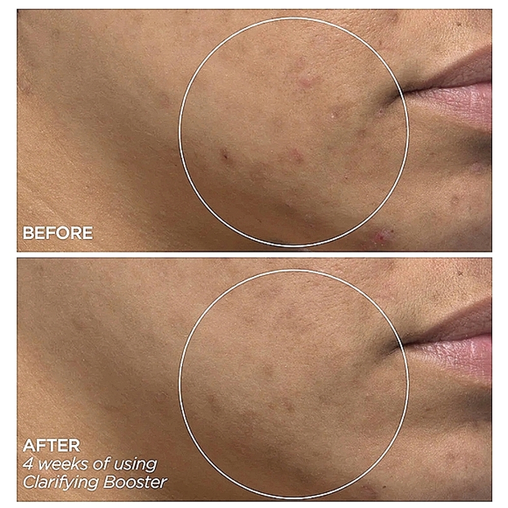 NEW BeautyBio Salicylic Acid Clarifying Booster Serum Acne Spot Treatment 1oz. - Picture 5 of 7